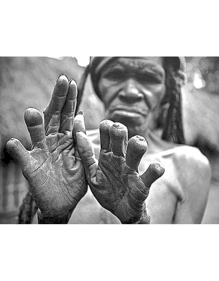Женщина из племени дани, у которой, согласно ритуалу, отрублены фаланги пальцев – по числу умерших близких родственников. Индонезия. 2009 г. Фотография Ulet Ifansasti / Getty Images
